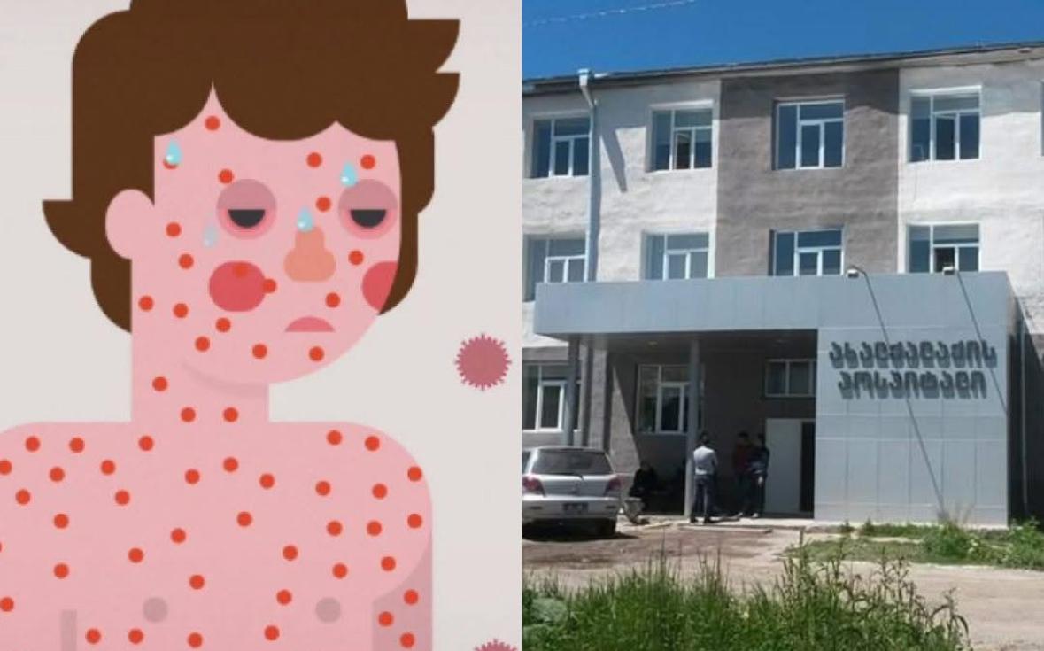 В Джавакхети выявлено 5 случаев кори